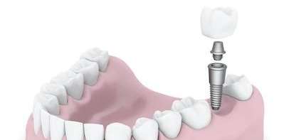 A 3D-rendered digital illustration of a dental implant procedure.
